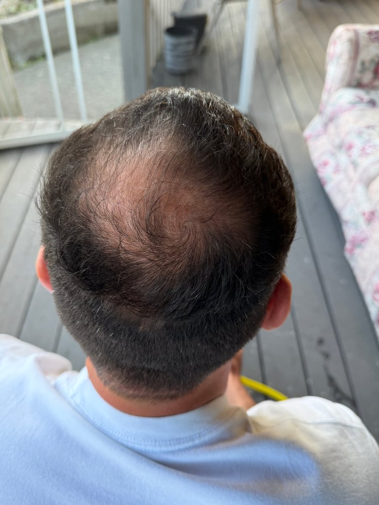 Back view of mans head showing male pattern baldness and hair loss on crown area