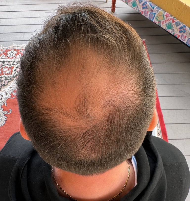 Top view of a mans head showing significant hair loss and receding hairline, wearing a black hoodie and chain necklace