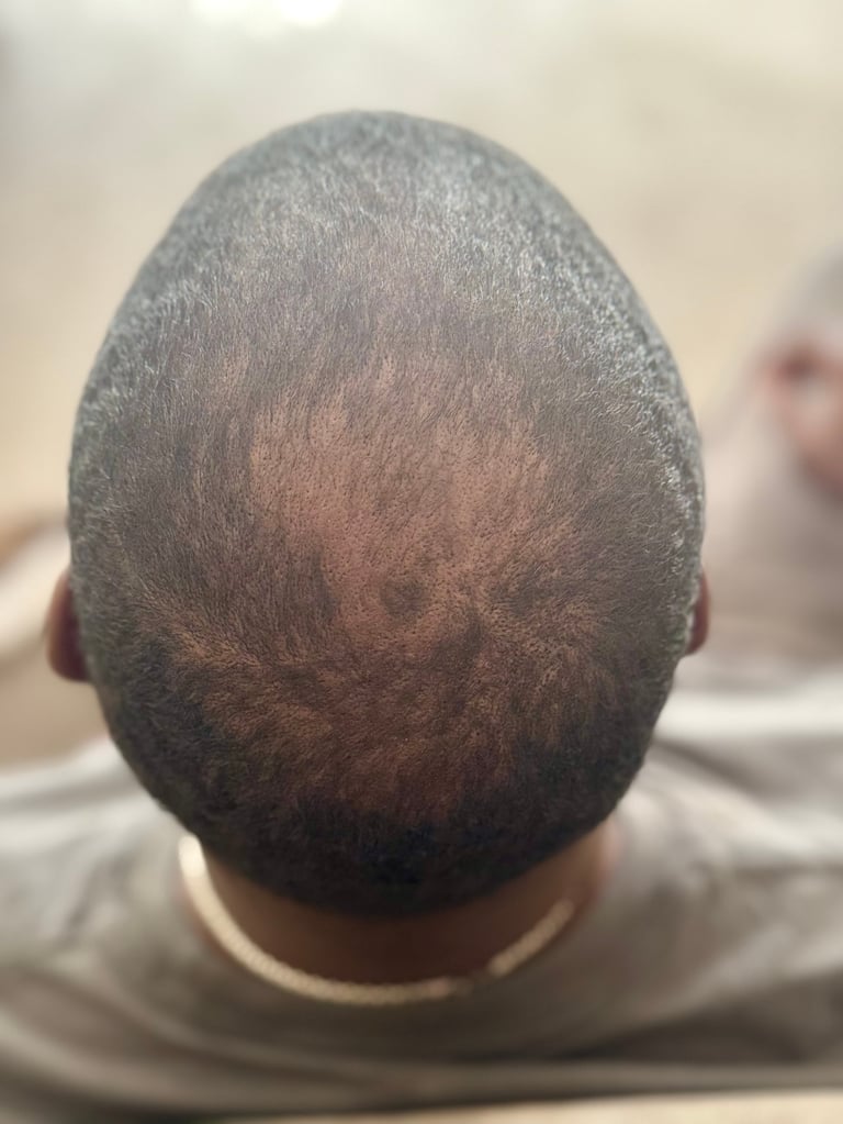 Back of persons head showing short hair with visible scalp, wearing light colored shirt