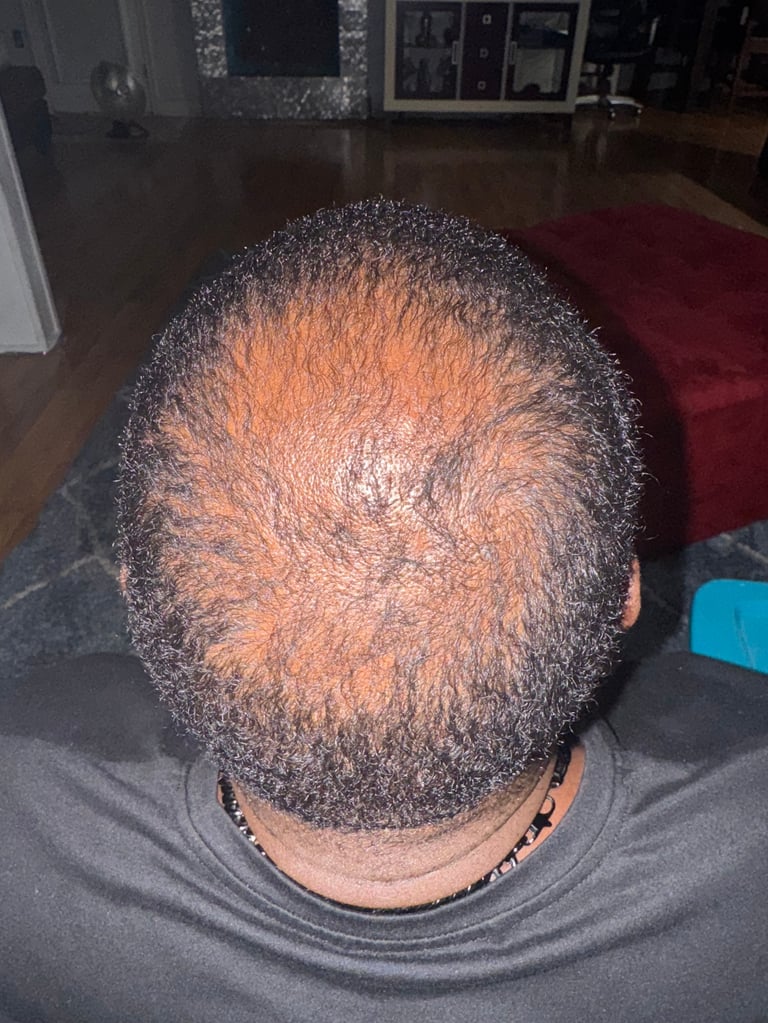 Top view of a persons head showing male pattern baldness with thinning hair and visible scalp